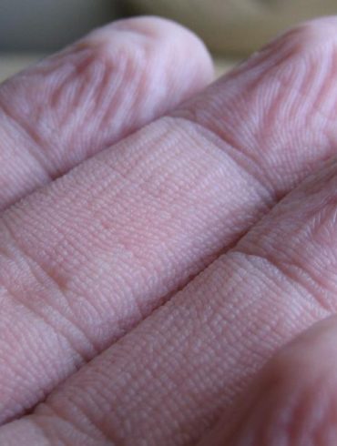 Why Fingers Wrinkle in Water